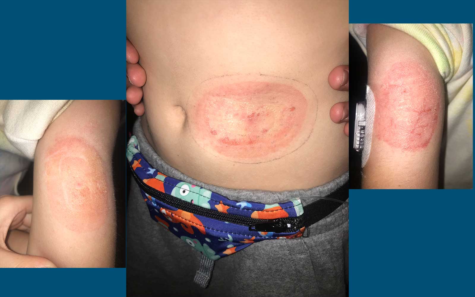 Dexcom Troubleshooting: Quick Fixes for Accurate Glucose Readings